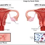 ویروس HPV چیست