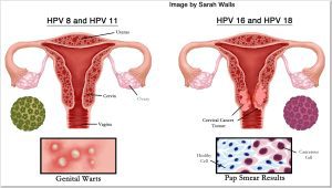 ویروس HPV چیست