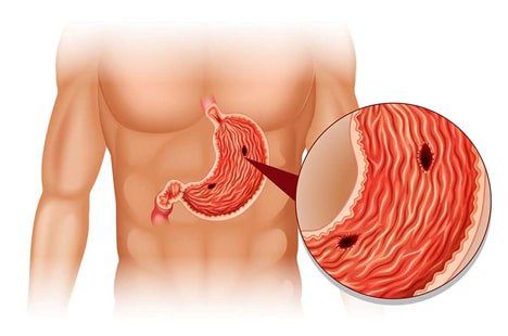 برای زخم معده چی بخوریم
