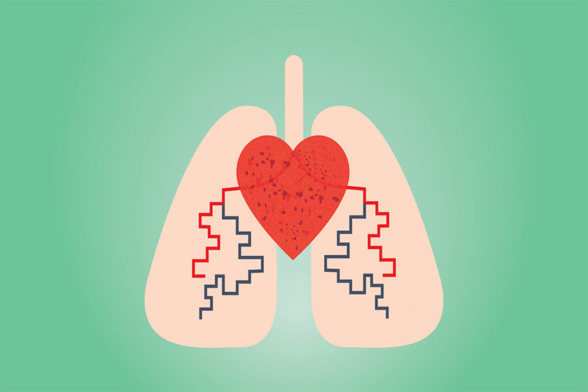 آمبولی ریه چه عوارضی دارد؟ آمبولی ریه چه عوارضی دارد؟