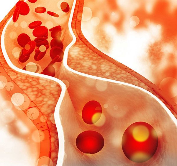 برای کاهش کلسترل خون چه باید کرد؟