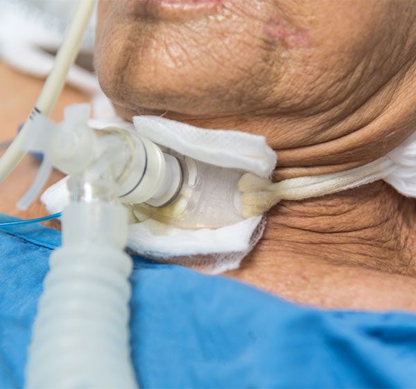 مراقبت از تراکئوستومی در خانه