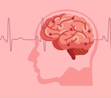 نحوه مراقبت از بیمار سکته مغزی در خانه