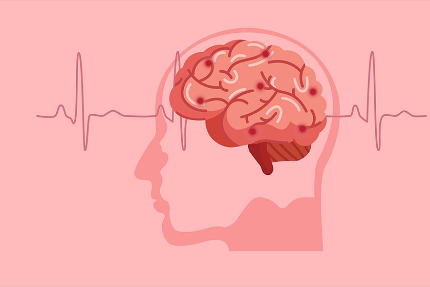 نحوه مراقبت از بیمار سکته مغزی در خانه نحوه مراقبت از بیمار سکته مغزی در خانه