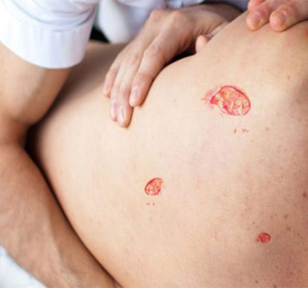 درمان زخم بستر در منزل