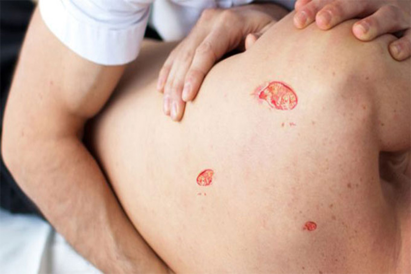 درمان زخم بستر در منزل درمان زخم بستر در منزل