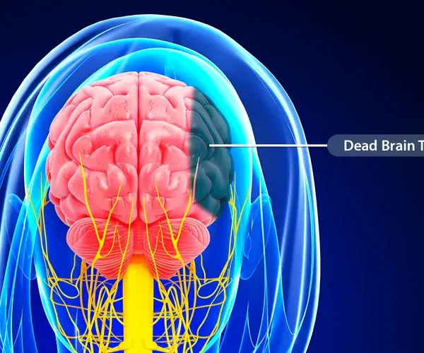 علائم سکته مغزی خاموش چیست