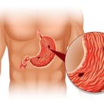 برای زخم معده چی بخوریم