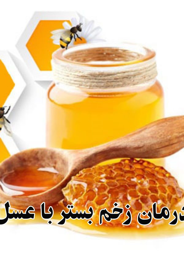 درمان زخم بستر با عسل