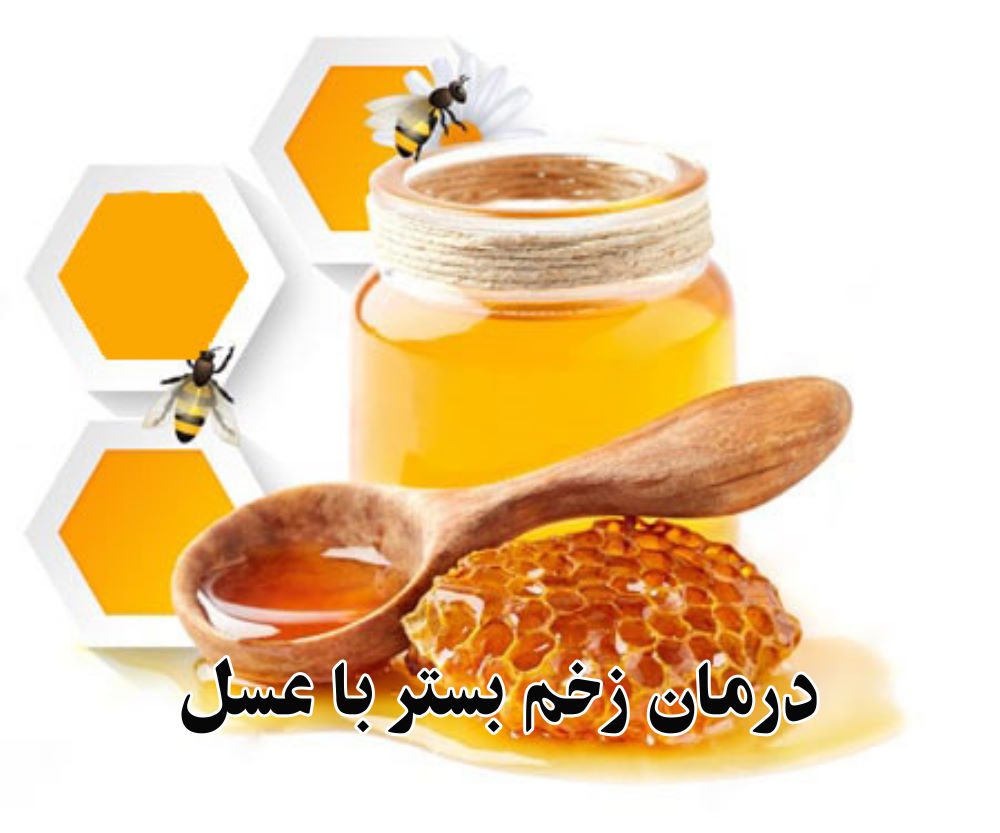درمان زخم بستر با عسل