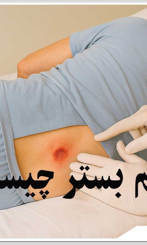 زخم بستر چیست